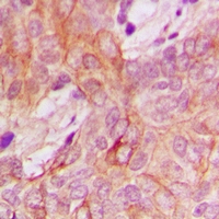 PPM1K Antibody - Immunohistochemical analysis of PPM1K staining in human breast cancer formalin fixed paraffin embedded tissue section. The section was pre-treated using heat mediated antigen retrieval with sodium citrate buffer (pH 6.0). The section was then incubated with the antibody at room temperature and detected with HRP and DAB as chromogen. The section was then counterstained with hematoxylin and mounted with DPX.