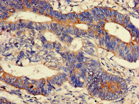 PPM1K Antibody - Immunohistochemistry of paraffin-embedded human colon cancer using PPM1K Antibody at dilution of 1:100