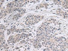 PPM1K Antibody - Immunohistochemistry of paraffin-embedded Human colorectal cancer tissue  using PPM1K Polyclonal Antibody at dilution of 1:55(×200)
