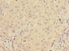 PPM1M Antibody - Immunohistochemistry of paraffin-embedded human liver cancer using antibody at dilution of 1:100.