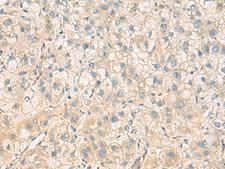 PPM1M Antibody - Immunohistochemistry of paraffin-embedded Human liver cancer tissue  using PPM1M Polyclonal Antibody at dilution of 1:100(×200)
