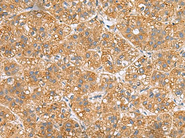 PPM1M Antibody - Immunohistochemistry of paraffin-embedded Human liver cancer tissue  using PPM1M Polyclonal Antibody at dilution of 1:50(×200)