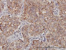 PPOX Antibody - Immunoperoxidase of monoclonal antibody to PPOX on formalin-fixed paraffin-embedded human lung, adenosquamous cell carcinoma. [antibody concentration 3 ug/ml].