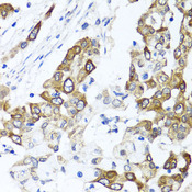 PPOX Antibody - Immunohistochemistry of paraffin-embedded human colon carcinoma tissue.