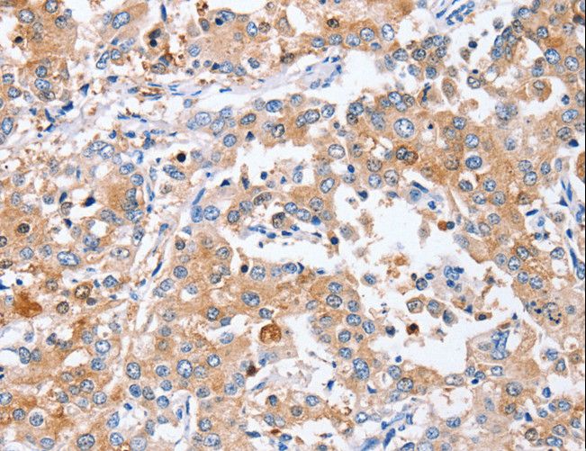PPOX Antibody - Immunohistochemistry of paraffin-embedded Human liver cancer using PPOX Polyclonal Antibody at dilution of 1:40.