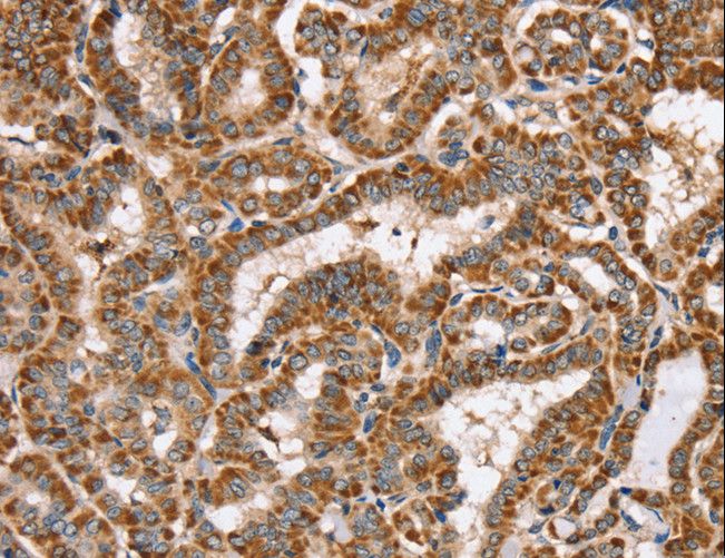 PPOX Antibody - Immunohistochemistry of paraffin-embedded Human thyroid cancer using PPOX Polyclonal Antibody at dilution of 1:40.