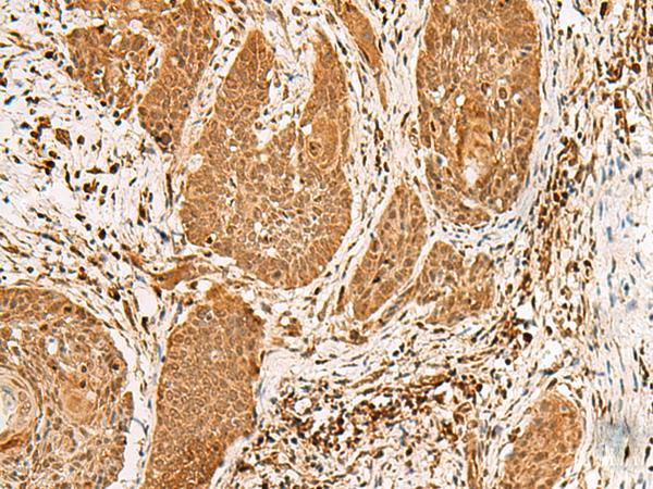 PPOX Antibody - Immunohistochemistry of paraffin-embedded Human esophagus cancer tissue  using PPOX Polyclonal Antibody at dilution of 1:30(×200)