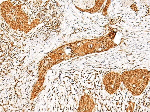 PPOX Antibody - Immunohistochemistry of paraffin-embedded Human esophagus cancer tissue  using PPOX Polyclonal Antibody at dilution of 1:45(×200)