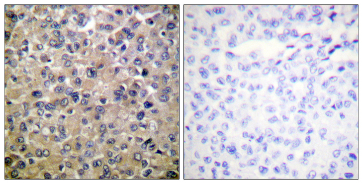 PPP1CA / PP1-Alpha Antibody - Immunohistochemistry analysis of paraffin-embedded human breast carcinoma tissue, using PP1-alpha Antibody. The picture on the right is blocked with the synthesized peptide.