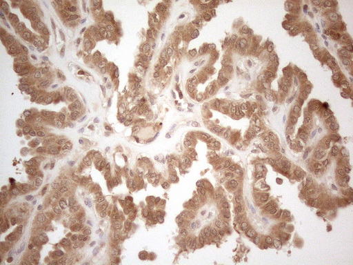 PPP1CA / PP1-Alpha Antibody - Immunohistochemical staining of paraffin-embedded Carcinoma of Human thyroid tissue using anti-PPP1CA mouse monoclonal antibody. (Heat-induced epitope retrieval by 1mM EDTA in 10mM Tris buffer. (pH8.5) at 120°C for 3 min. (1:150)