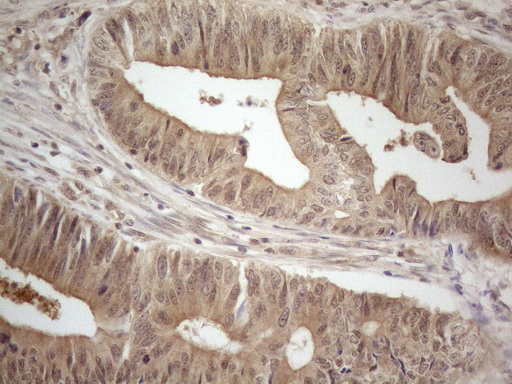 PPP1CA / PP1-Alpha Antibody - Immunohistochemical staining of paraffin-embedded Adenocarcinoma of Human colon tissue using anti-PPP1CA mouse monoclonal antibody. (Heat-induced epitope retrieval by 1mM EDTA in 10mM Tris buffer. (pH8.5) at 120°C for 3 min. (1:150)