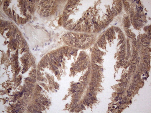 PPP1CA / PP1-Alpha Antibody - Immunohistochemical staining of paraffin-embedded Adenocarcinoma of Human ovary tissue using anti-PPP1CA mouse monoclonal antibody. (Heat-induced epitope retrieval by 1mM EDTA in 10mM Tris buffer. (pH8.5) at 120°C for 3 min. (1:150)
