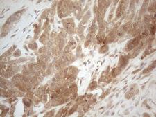 PPP1CA / PP1-Alpha Antibody - Immunohistochemical staining of paraffin-embedded Adenocarcinoma of Human endometrium tissue using anti-PPP1CA mouse monoclonal antibody. (Heat-induced epitope retrieval by 1mM EDTA in 10mM Tris buffer. (pH8.5) at 120°C for 3 min. (1:150)