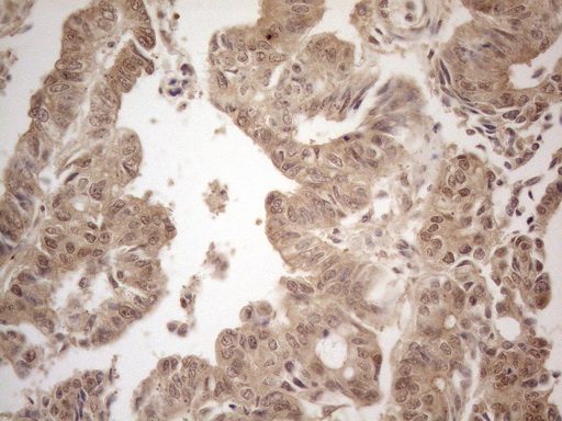 PPP1CA / PP1-Alpha Antibody - Immunohistochemical staining of paraffin-embedded Human colon tissue using anti-PPP1CA mouse monoclonal antibody. (Heat-induced epitope retrieval by 1mM EDTA in 10mM Tris buffer. (pH8.5) at 120°C for 3 min. (1:150)
