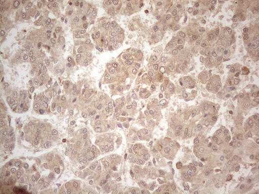 PPP1CA / PP1-Alpha Antibody - Immunohistochemical staining of paraffin-embedded Carcinoma of Human liver tissue using anti-PPP1CA mouse monoclonal antibody. (Heat-induced epitope retrieval by 1mM EDTA in 10mM Tris buffer. (pH8.5) at 120°C for 3 min. (1:150)