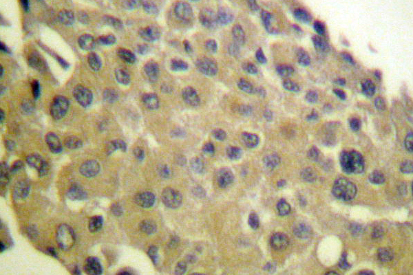 PPP1CA / PP1-Alpha Antibody - IHC of PP1 (G315) pAb in paraffin-embedded human breast carcinoma tissue.