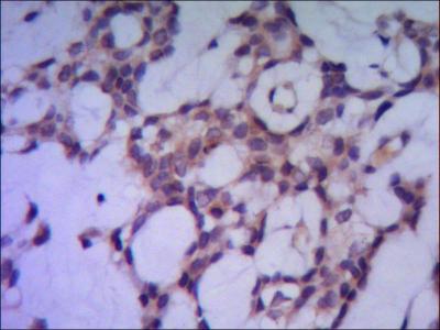PPP1CA / PP1-Alpha Antibody - IHC of paraffin-embedded human breast cancer using anti-PPP1A mouse monoclonal antibody diluted 1/500-1/1000.