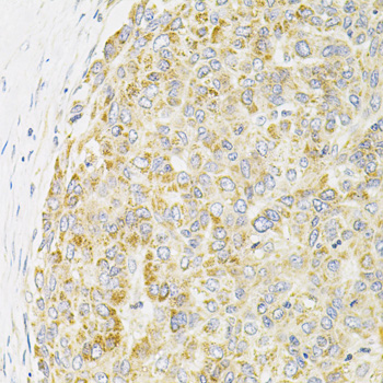 PPP1CA / PP1-Alpha Antibody - Immunohistochemistry of paraffin-embedded human liver cancer using PPP1CA antibody at dilution of 1:100 (40x lens).