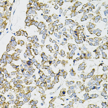 PPP1CA / PP1-Alpha Antibody - Immunohistochemistry of paraffin-embedded human esophageal cancer using PPP1CA antibody at dilution of 1:100 (40x lens).