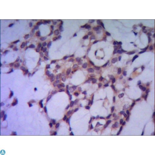 PPP1CA / PP1-Alpha Antibody - IHC of paraffin-embedded human breast cancer using anti-PPP1A mouse mAb diluted 1:500-1:1000.