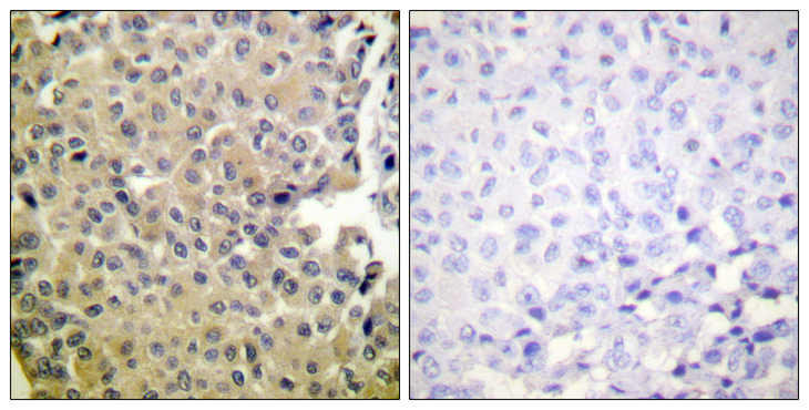 PPP1CA / PP1-Alpha Antibody - Immunohistochemistry analysis of paraffin-embedded human breast carcinoma, using PP1-alpha (Phospho-Thr320) Antibody. The picture on the right is blocked with the phospho peptide.