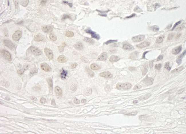 PPP1CB Antibody - Detection of Human PPP1CB by Immunohistochemistry. Sample: FFPE section of human breast carcinoma. Antibody: Affinity purified rabbit anti-PPP1CB used at a dilution of 1:250. Epitope Retrieval Buffer-High pH (IHC-101J) was substituted for Epitope Retrieval Buffer-Reduced pH.