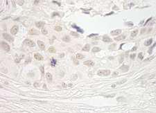 PPP1CB Antibody - Detection of Human PPP1CB by Immunohistochemistry. Sample: FFPE section of human breast carcinoma. Antibody: Affinity purified rabbit anti-PPP1CB used at a dilution of 1:250. Epitope Retrieval Buffer-High pH (IHC-101J) was substituted for Epitope Retrieval Buffer-Reduced pH.