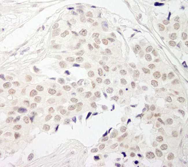 PPP1CB Antibody - Detection of Human PPP1CB by Immunohistochemistry. Sample: FFPE section of human breast carcinoma. Antibody: Affinity purified rabbit anti-PPP1CB used at a dilution of 1:200 (1 ug/ml). Detection: DAB.