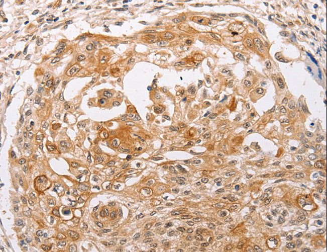 PPP1CB Antibody - Immunohistochemistry of paraffin-embedded Human cervical cancer using PPP1CB Polyclonal Antibody at dilution of 1:30.