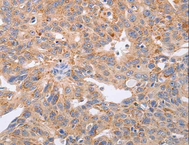 PPP1CB Antibody - Immunohistochemistry of paraffin-embedded Human lung cancer using PPP1CB Polyclonal Antibody at dilution of 1:40.