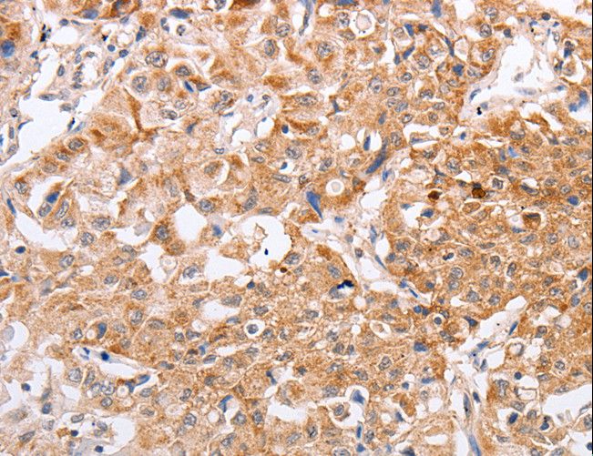 PPP1CB Antibody - Immunohistochemistry of paraffin-embedded Human lung cancer using PPP1CB Polyclonal Antibody at dilution of 1:40.