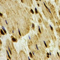 PPP1CB Antibody - Immunohistochemical analysis of PP1 beta staining in human esophageal cancer formalin fixed paraffin embedded tissue section. The section was pre-treated using heat mediated antigen retrieval with sodium citrate buffer (pH 6.0). The section was then incubated with the antibody at room temperature and detected using an HRP conjugated compact polymer system. DAB was used as the chromogen. The section was then counterstained with hematoxylin and mounted with DPX.