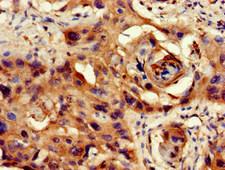 PPP1CB Antibody - Immunohistochemistry of paraffin-embedded human cervical cancer at dilution of 1:100
