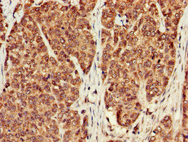 PPP1CB Antibody - Immunohistochemistry of paraffin-embedded human ovarian cancer at dilution of 1:100