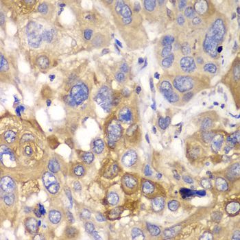 PPP1CB Antibody - Immunohistochemistry of paraffin-embedded human esophageal cancer using PPP1CB antibody at dilution of 1:100 (40x lens).