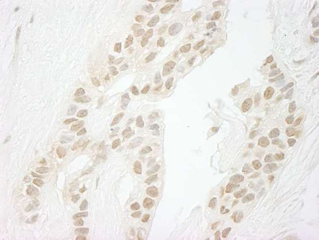 PPP1CC / PP1 Gamma Antibody - Detection of Human PPP1CC by Immunohistochemistry. Sample: FFPE section of human breast carcinoma. Antibody: Affinity purified rabbit anti-PPP1CC used at a dilution of 1:250. Epitope Retrieval Buffer-High pH (IHC-101J) was substituted for Epitope Retrieval Buffer-Reduced pH.