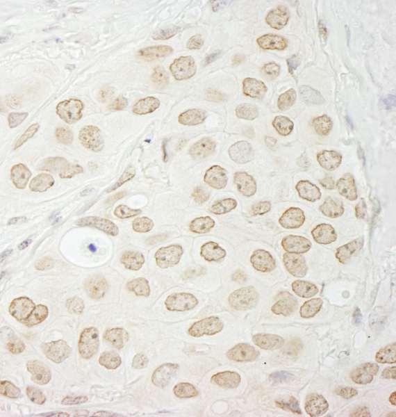 PPP1CC / PP1 Gamma Antibody - Detection of Human PPP1CC by Immunohistochemistry. Sample: FFPE section of human breast carcinoma. Antibody: Affinity purified rabbit anti-PPP1CC used at a dilution of 1:1000 (1 ug/ml). Detection: DAB.