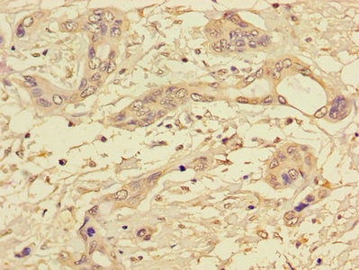 PPP1CC / PP1 Gamma Antibody - Immunohistochemistry of paraffin-embedded human pancreatic cancer using PPP1CC Antibody at dilution of 1:100