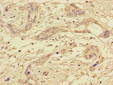 PPP1CC / PP1 Gamma Antibody - Immunohistochemistry of paraffin-embedded human pancreatic cancer using PPP1CC Antibody at dilution of 1:100