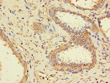 PPP1CC / PP1 Gamma Antibody - Immunohistochemistry of paraffin-embedded human prostate cancer using PPP1CC Antibody at dilution of 1:100