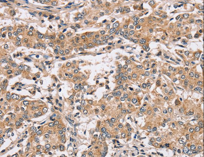 PPP1CC / PP1 Gamma Antibody - Immunohistochemistry of paraffin-embedded Human liver cancer using PPP1CC Polyclonal Antibody at dilution of 1:40.