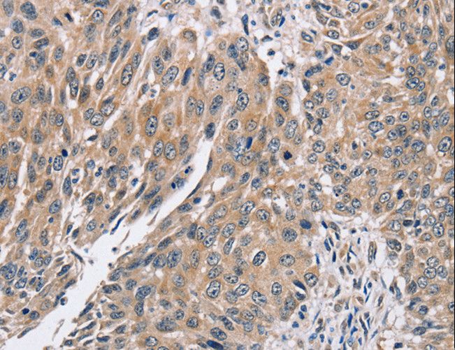 PPP1CC / PP1 Gamma Antibody - Immunohistochemistry of paraffin-embedded Human lung cancer using PPP1CC Polyclonal Antibody at dilution of 1:40.