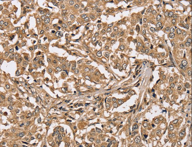 PPP1CC / PP1 Gamma Antibody - Immunohistochemistry of paraffin-embedded Human liver cancer using PPP1CC Polyclonal Antibody at dilution of 1:40.