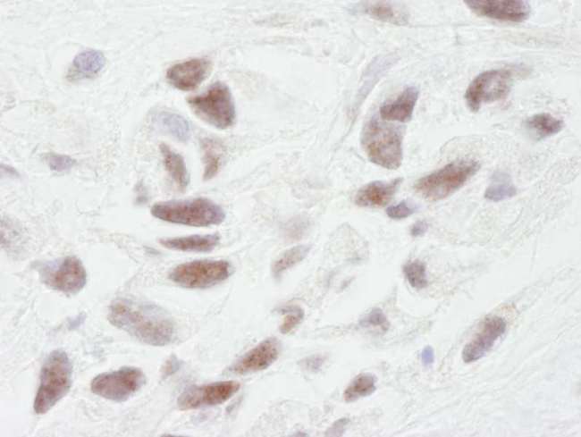 PPP1R10 / PNUTS Antibody - Detection of Human PNUTS by Immunohistochemistry. Sample: FFPE section of human breast adenocarcinoma. Antibody: Affinity purified rabbit anti-PNUTS used at a dilution of 1:250. Detection: DAB.