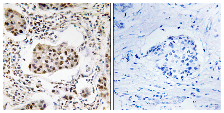 PPP1R11 Antibody - Immunohistochemistry analysis of paraffin-embedded human breast carcinoma tissue, using PPP1R11 Antibody. The picture on the right is blocked with the synthesized peptide.