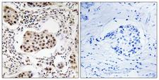 PPP1R11 Antibody - Peptide - + Immunohistochemistry analysis of paraffin-embedded human breast carcinoma tissue using PPP1R11 antibody.