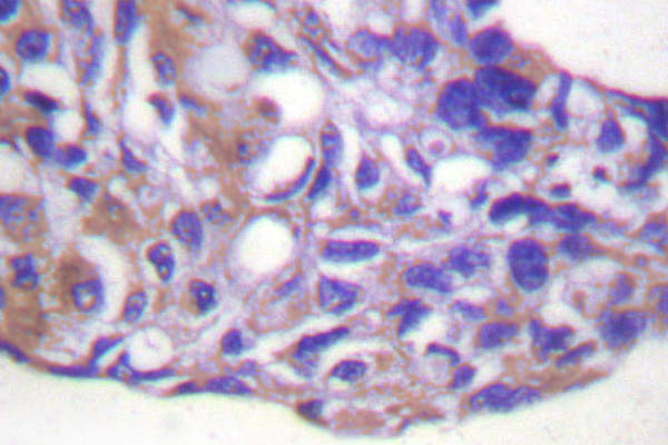 PPP1R12A / MYPT1 Antibody - IHC of MYPT1 (R690) pAb in paraffin-embedded human breast carcinoma tissue.