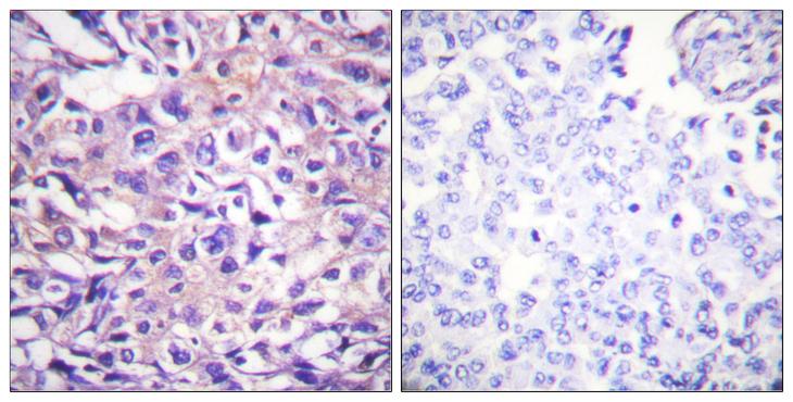 PPP1R12A / MYPT1 Antibody - P-peptide - + Immunohistochemistry analysis of paraffin-embedded human breast carcinoma tissue using MYPT1 (Phospho-Thr696) antibody.