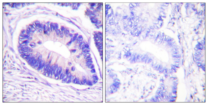 PPP1R12A / MYPT1 Antibody - Immunohistochemistry analysis of paraffin-embedded human colon carcinoma, using MYPT1 (Phospho-Thr853) Antibody. The picture on the right is blocked with the phospho peptide.