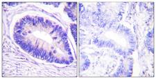 PPP1R12A / MYPT1 Antibody - P-peptide - + Immunohistochemistry analysis of paraffin-embedded human colon carcinoma tissue using MYPT1 (Phospho-Thr853) antibody.